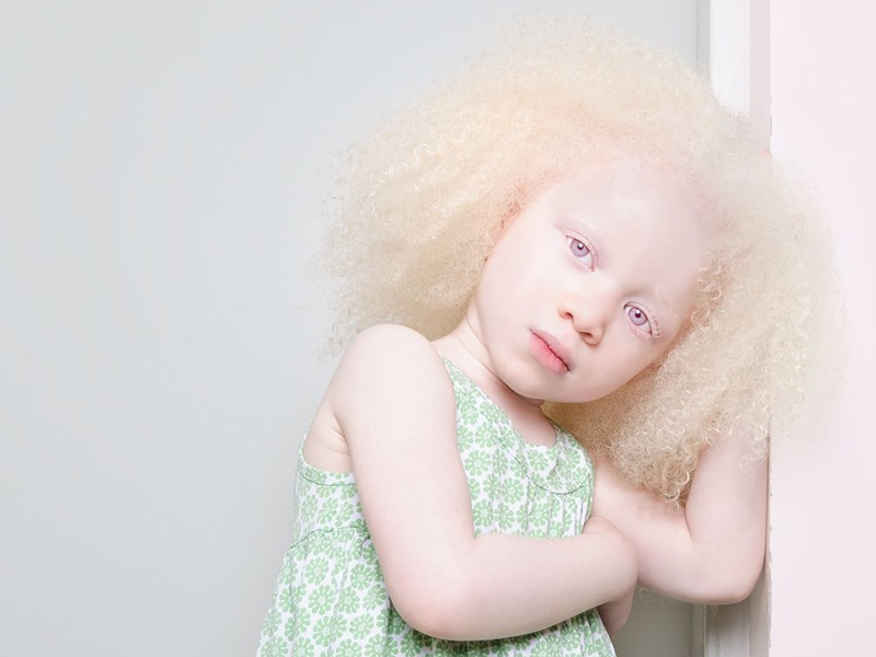 Альбинизмом страдают. Десислава альбинос.